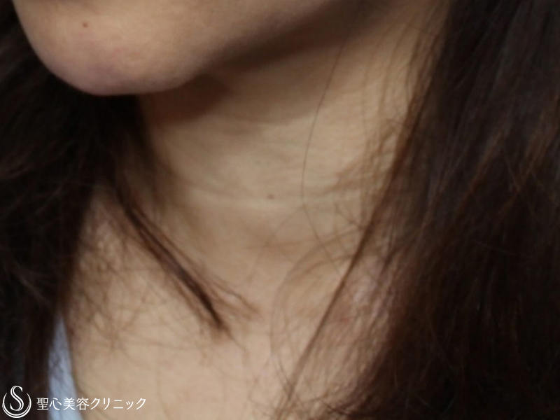 【50代女性・首の横じわの治療】プレミアムPRP皮膚再生療法（2年後） Before 