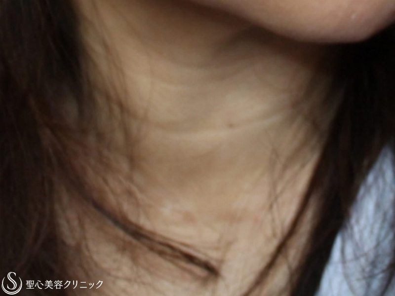 【50代女性・首の横じわの治療】プレミアムPRP皮膚再生療法（2年後） Before 