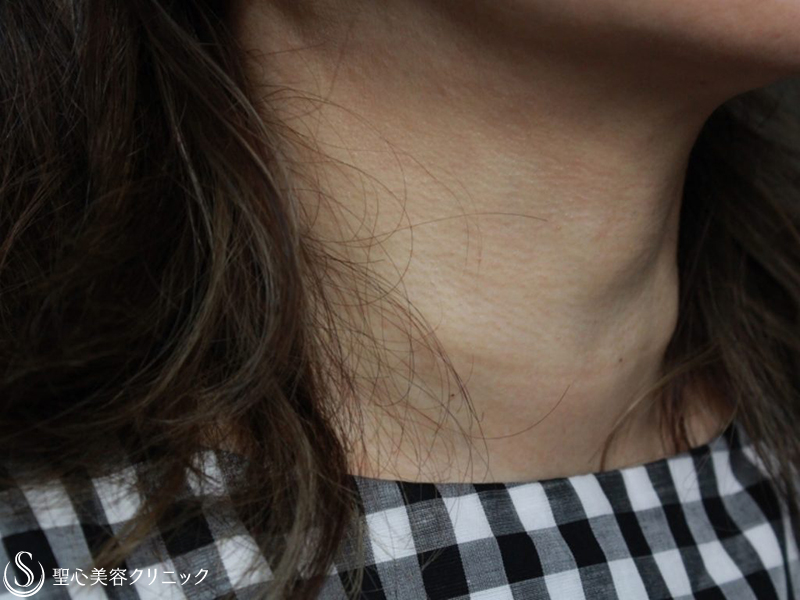 【50代女性・首の横じわの治療】プレミアムPRP皮膚再生療法（2年後） After 