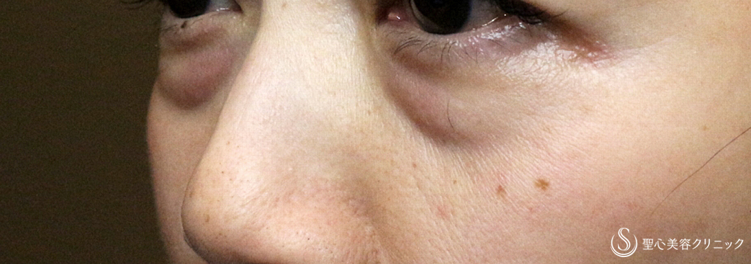 【50代女性・目の下のクマ＆タルミ】表ハムラ+α法「Ver.2」単独（5年後） Before 