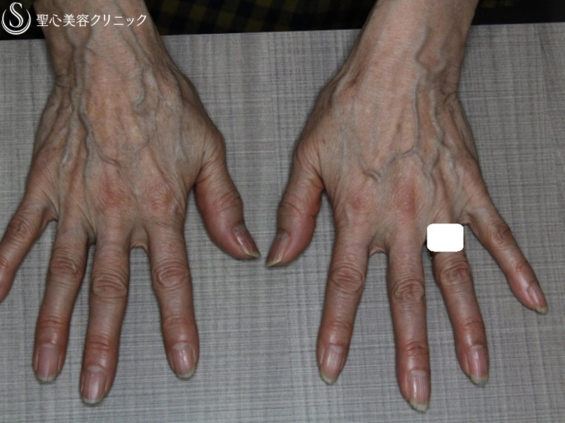 【60代女性・手の甲の若返り】プレミアムPRP皮膚再生療法（半年後） Before 