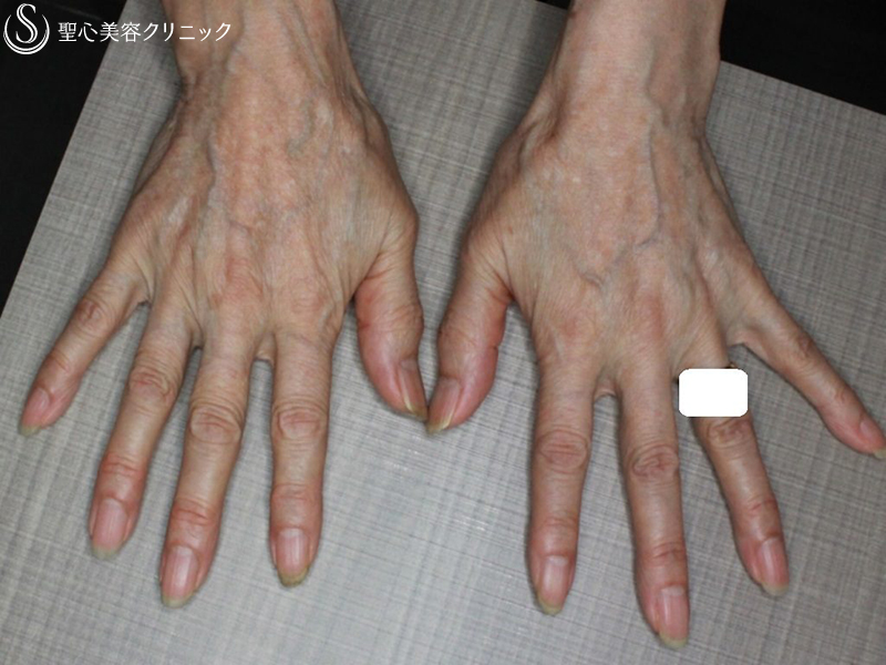 【60代女性・手の甲の若返り】プレミアムPRP皮膚再生療法（半年後） After 