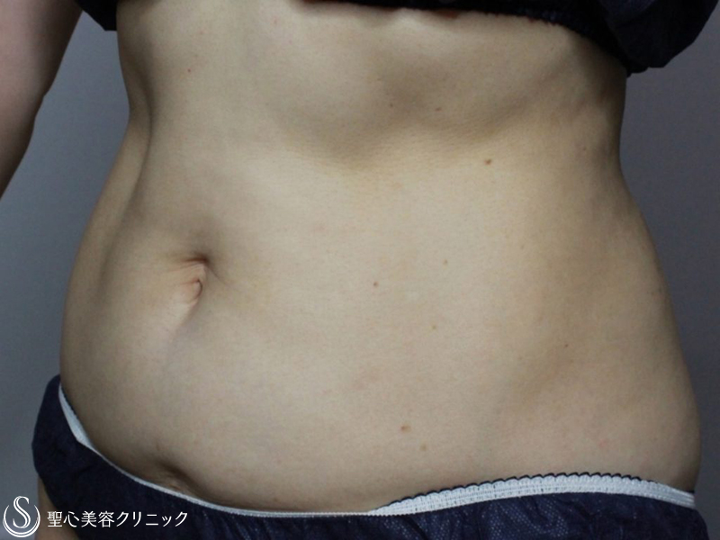 【40代女性・腹部】リポセル（1ヶ月後） Before 