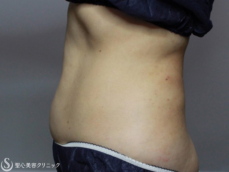 【40代女性・腹部】リポセル（1ヶ月後） Before 