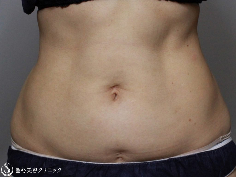【40代女性・腹部】リポセル（1ヶ月後） After 