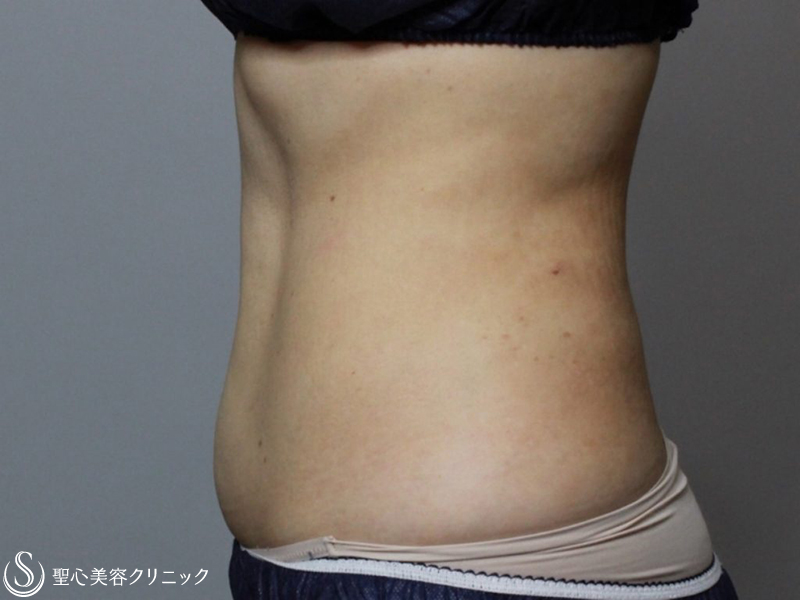【40代女性・腹部】リポセル（1ヶ月後） After 