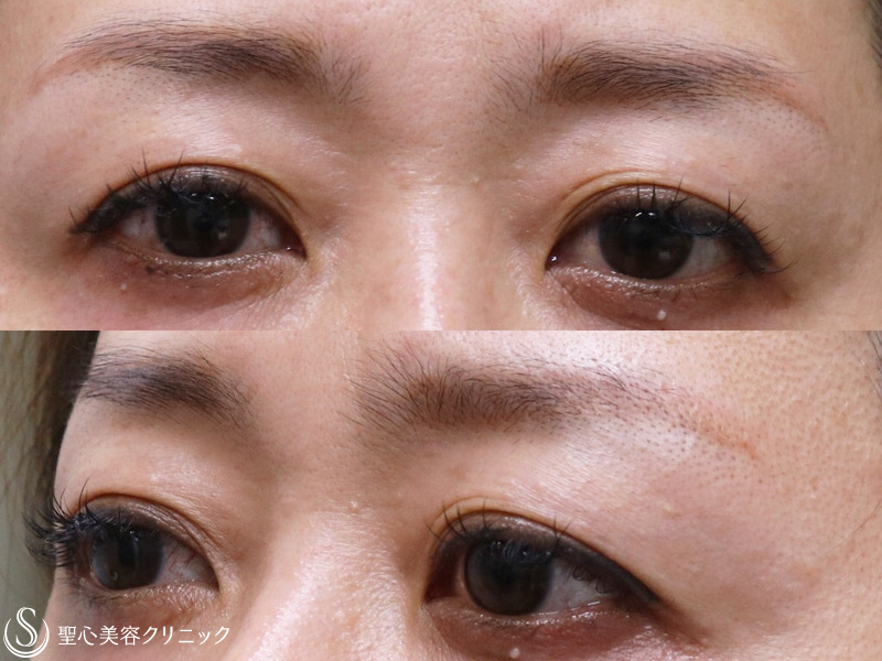 【40代女性・若々しい目元に】眉下切開+目尻切開（1ヶ月後） Before 