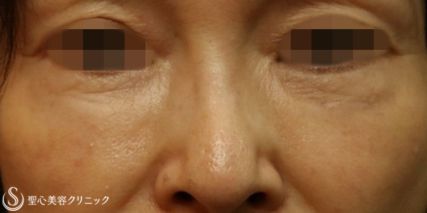 【50代女性・自然な若返り（目の下・マリオネットライン・額）】プレミアムPRP皮膚再生療法（6ヶ月後） Before 