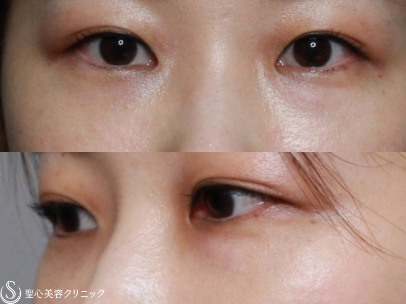【30代女性・目の下のクマとたるみの改善】プレミアムPRP皮膚再生療法（2ヶ月後） After 