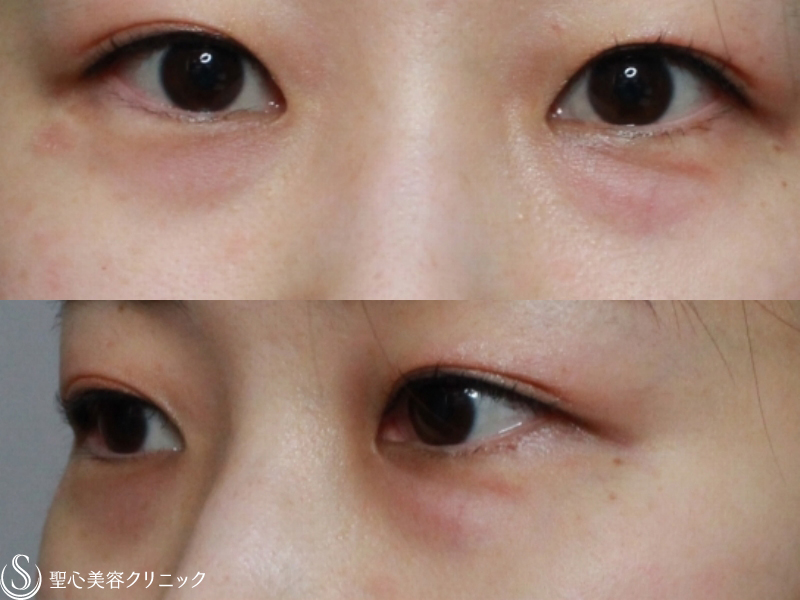 【30代女性・目の下のクマとたるみの改善】プレミアムPRP皮膚再生療法（2ヶ月後） Before 