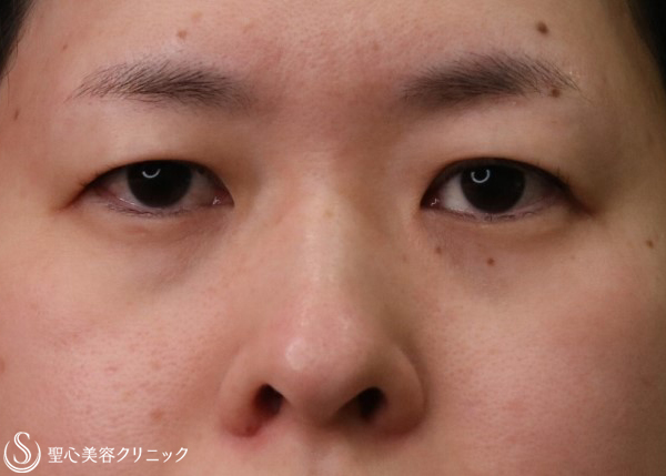 【30代女性・まぶたのたるみ、鼻】眉下切開、鼻孔縁下降術（4ヶ月後） Before 