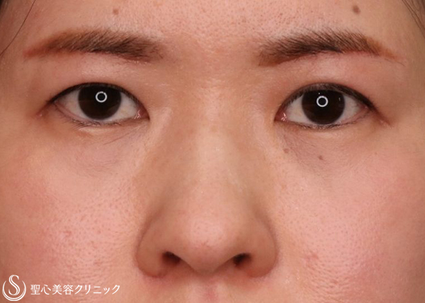 【30代女性・まぶたのたるみ、鼻】眉下切開、鼻孔縁下降術（4ヶ月後） After 