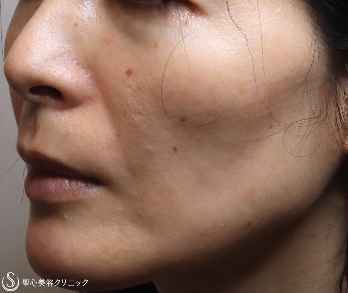 【40代女性・顔全体のアンチエイジング】プレミアムPRP皮膚再生療法（1ヶ月後） Before 
