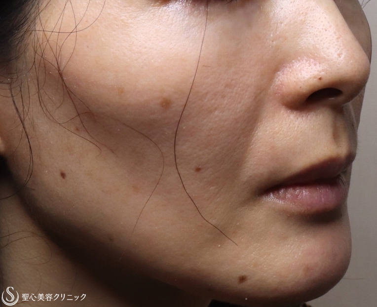 【40代女性・顔全体のアンチエイジング】プレミアムPRP皮膚再生療法（1ヶ月後） Before 