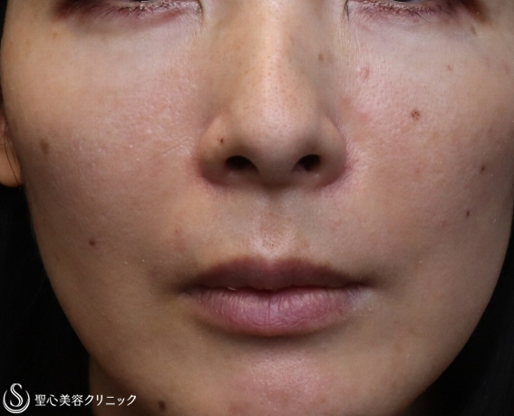 【40代女性・顔全体のアンチエイジング】プレミアムPRP皮膚再生療法（1ヶ月後） After 