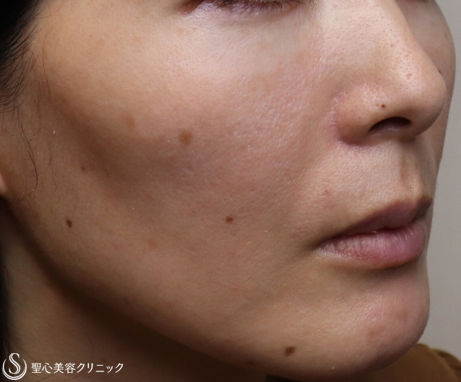 【40代女性・顔全体のアンチエイジング】プレミアムPRP皮膚再生療法（1ヶ月後） After 