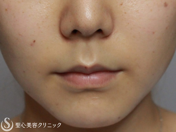 【20代女性・鼻下短縮術】リップリフト（1ヶ月後） Before 