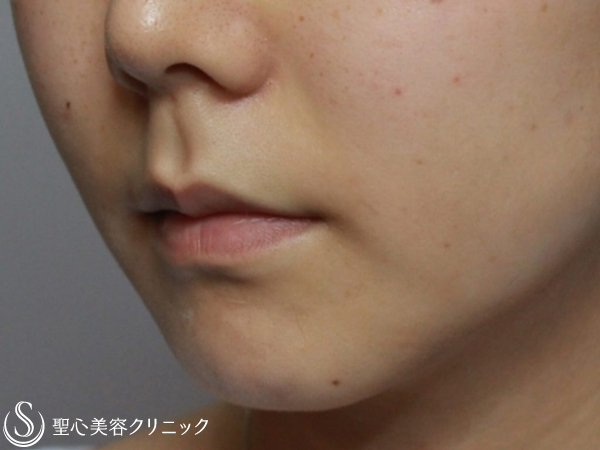 【20代女性・鼻下短縮術】リップリフト（1ヶ月後） Before 