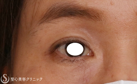【50代女性・瞼のたるみ改善で痛みも解消】マイクロメソッド＋α（1ヶ月後） After 