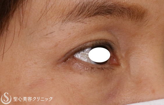 【50代女性・瞼のたるみ改善で痛みも解消】マイクロメソッド＋α（1ヶ月後） After 