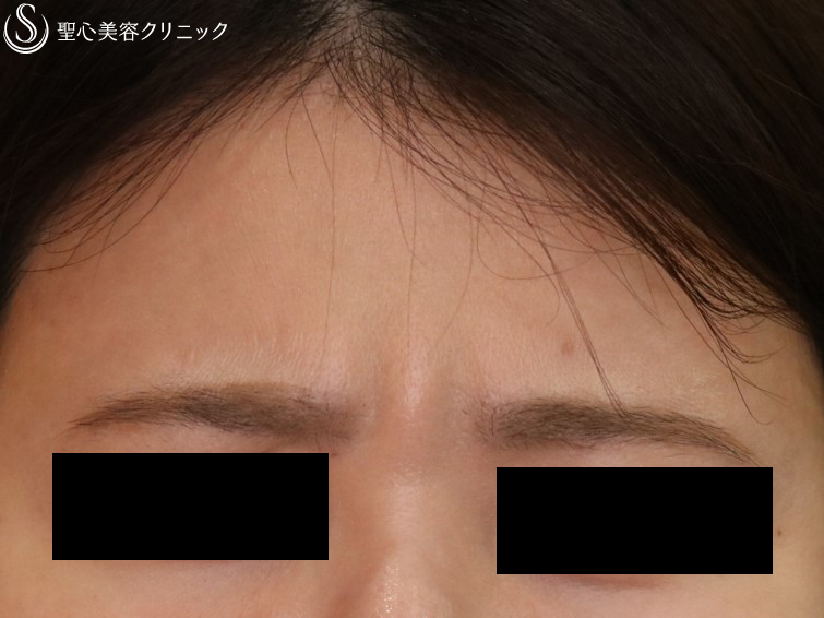 【30代女性・眉間のシワ】ボトックス注入（3ヶ月後） After 