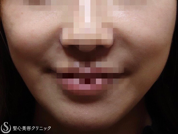 30代女性 ふっくらしたお顔がスッキリ 頬の脂肪吸引 8ヶ月後 症例写真 美容整形 美容外科なら聖心美容クリニック 30代女性 ふっくらしたお顔がスッキリ 頬の脂肪吸引 8ヶ月後 症例写真 美容整形 美容外科なら聖心美容クリニック