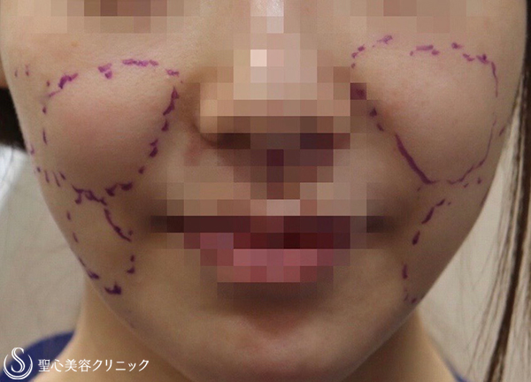 【30代女性・ふっくらしたお顔がスッキリ】頬の脂肪吸引（8ヶ月後） Before 