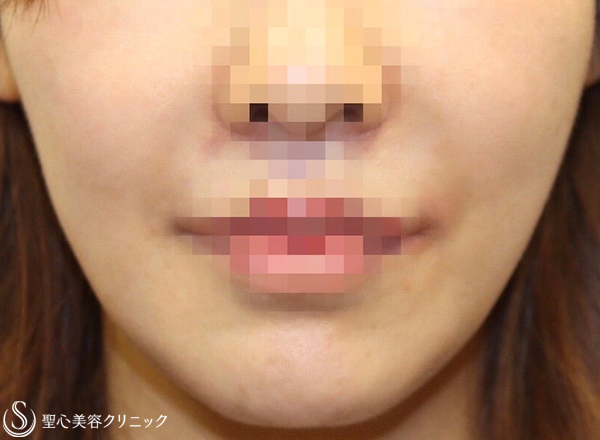 【30代女性・ふっくらしたお顔がスッキリ】頬の脂肪吸引（8ヶ月後） After 