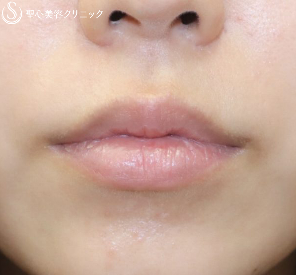 代女性 優しそうな可愛い唇に プレミアム口角挙上術 2ヶ月後 症例写真 美容整形 美容外科なら聖心美容クリニック