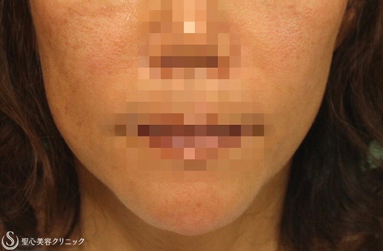 【60代女性・しっかりとリフトアップ】フェイスリフト(＋リガメント処置)、右頬脂肪吸引（3ヶ月後） Before 