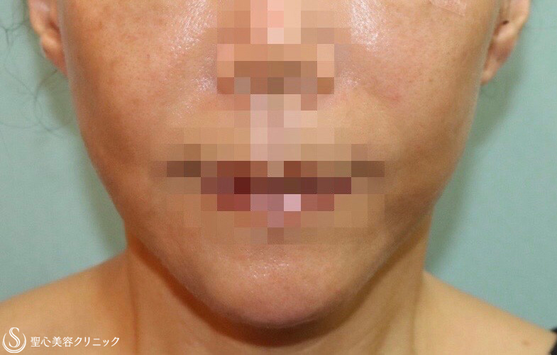 【60代女性・しっかりとリフトアップ】フェイスリフト(＋リガメント処置)、右頬脂肪吸引（3ヶ月後） After 