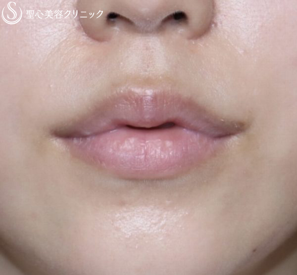 代女性 優しそうな可愛い唇に プレミアム口角挙上術 2ヶ月後 症例写真 美容整形 美容外科なら聖心美容クリニック
