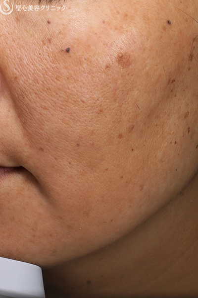 【40代女性・顔のシミ】ライムライト（1回）＋トラネキサム酸内服（1ヶ月後） After 