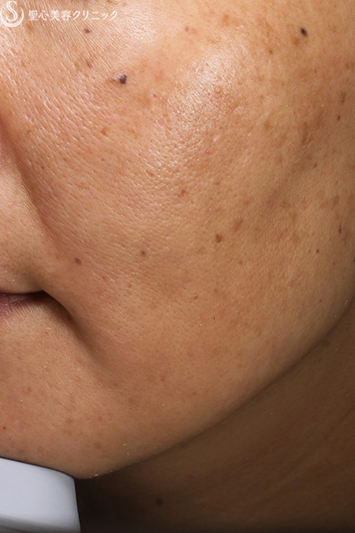 【40代女性・顔のシミ】ライムライト（1回）＋トラネキサム酸内服（1ヶ月後） After 