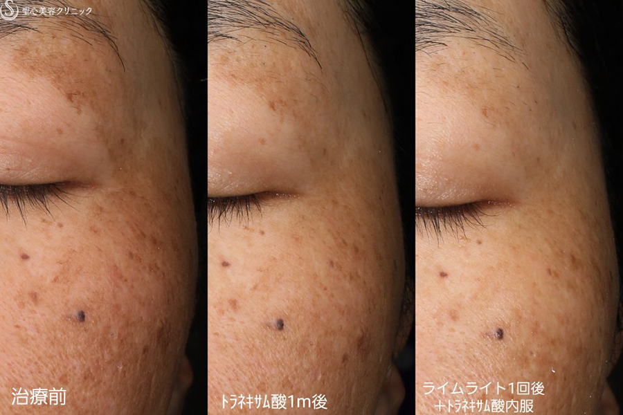 【40代女性・顔のシミ】ライムライト（1回）＋トラネキサム酸内服（1ヶ月後） After 