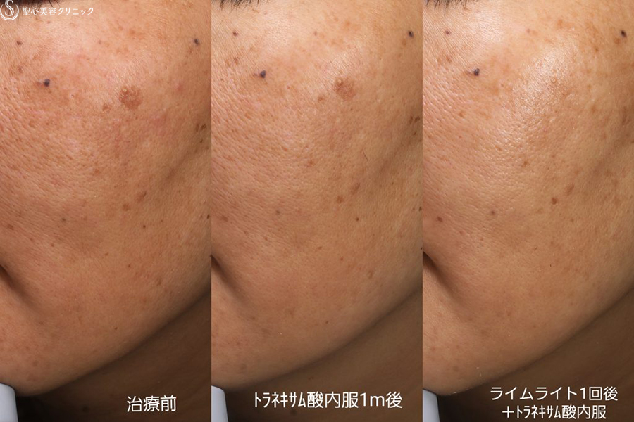 【40代女性・顔のシミ】ライムライト（1回）＋トラネキサム酸内服（1ヶ月後） After 