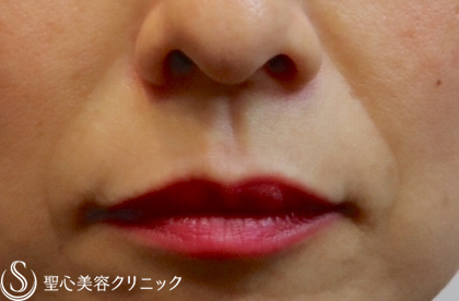 【40代女性・ほうれい線がずっと綺麗】プレミアムPRP皮膚再生療法（2年後） Before 