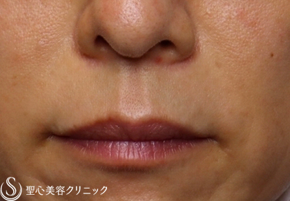 【40代女性・ほうれい線がずっと綺麗】プレミアムPRP皮膚再生療法（2年後） After 