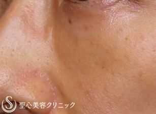 【40代女性・2年後も綺麗】プレミアムPRP皮膚再生療法（2年後） After 