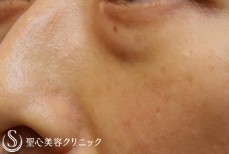 【40代女性・2年後も綺麗】プレミアムPRP皮膚再生療法（2年後） Before 