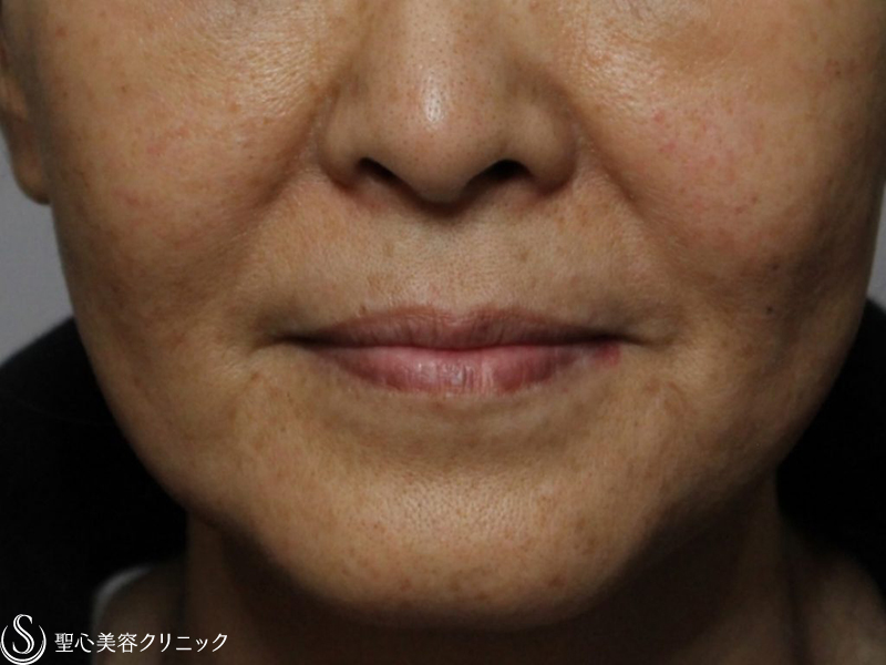 【50代女性・痩せても抜群の効果！！（法令線）】プレミアムPRP皮膚再生療法（5ヶ月後） Before 