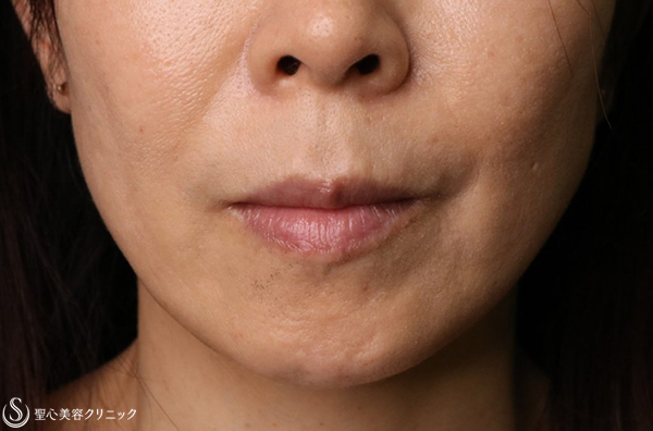 【50代女性・ほうれい線】プレミアムPRP皮膚再生療法（3年後） After 