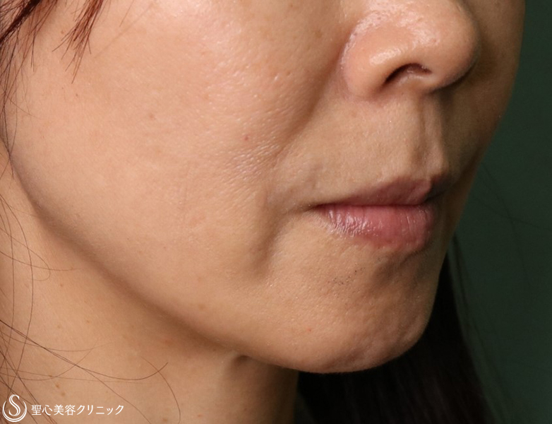 【50代女性・ほうれい線】プレミアムPRP皮膚再生療法（3年後） After 