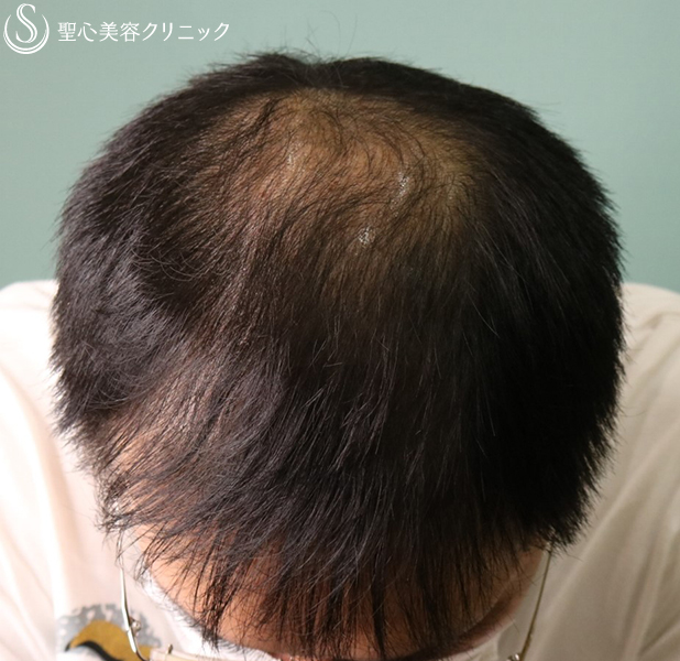 【30代男性・薄毛】ザガーロ、ミノキシジル（6ヶ月後・2年後） After 