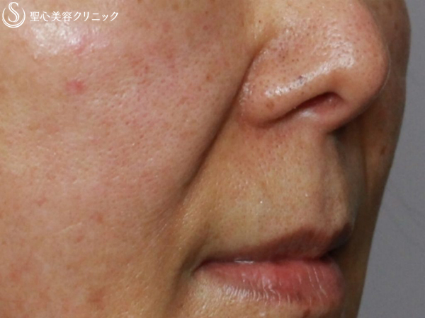 【70代女性・鼻下短縮術】リップリフト（3ヶ月後） Before 