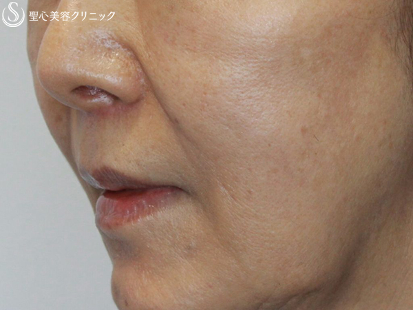 【70代女性・鼻下短縮術】リップリフト（3ヶ月後） After 