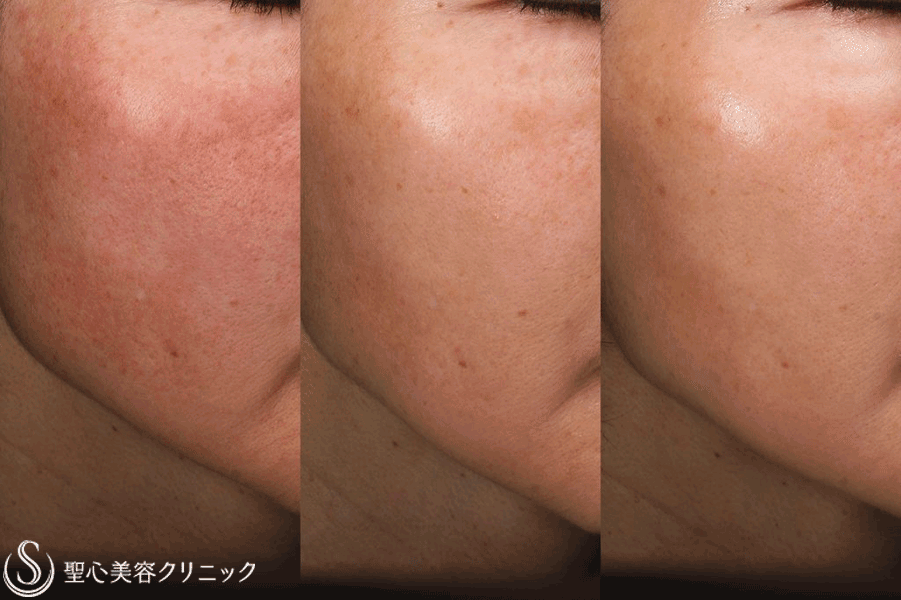 【50代女性・透明感のある肌に】トラネキサム酸錠内服（4ヶ月後）＋VAエッセンス外用（1ヶ月後） After 