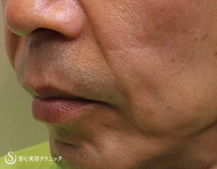 【50代男性・口元の若返り】プレミアムPRP皮膚再生療法（施術後2ヶ月） Before 