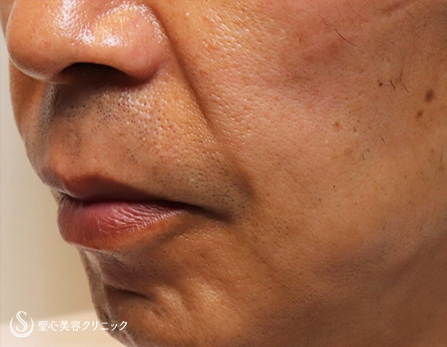 【50代男性・口元の若返り】プレミアムPRP皮膚再生療法（施術後2ヶ月） After 