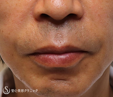 【50代男性・口元の若返り】プレミアムPRP皮膚再生療法（施術後2ヶ月） After 